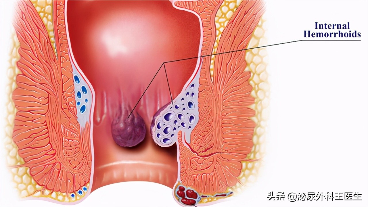 俗话说“十人九痔”，如何让高病发率的痔疮自愈？专家告诉你答案