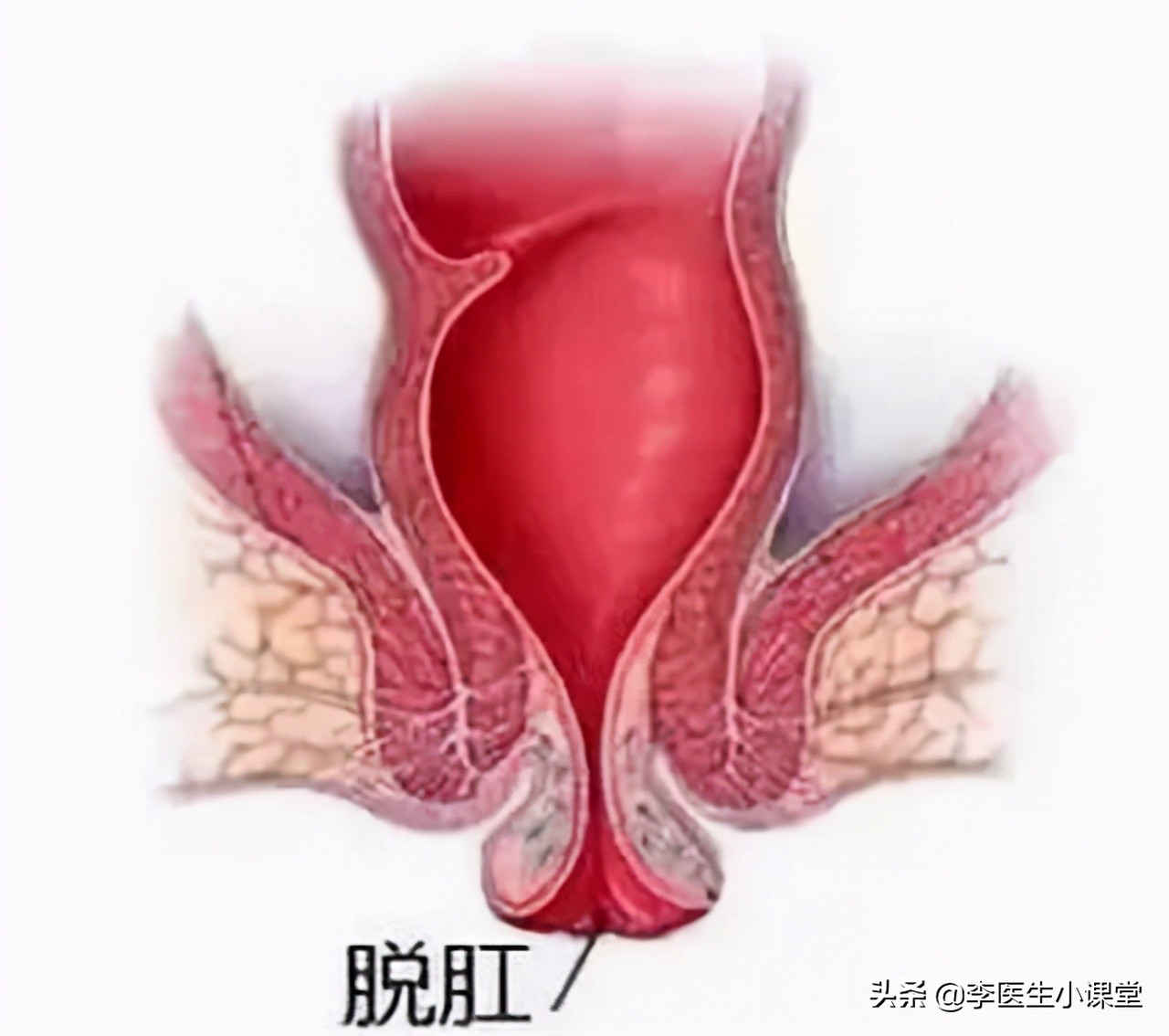 得了痔疮怎么办？医生：2个方法这么用，痔疮肉球没有了