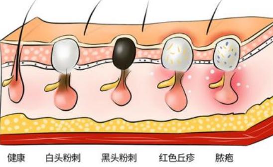 黑头是怎样产生的（黑头的形成原因）